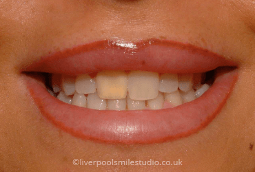 Discoloured Teeth